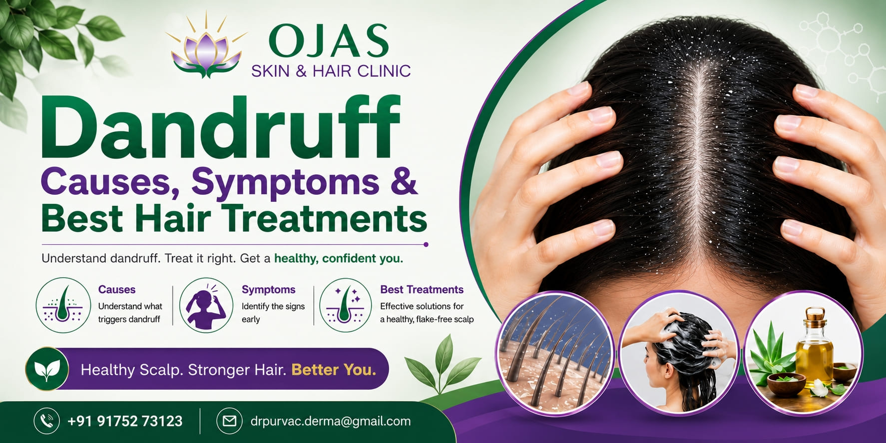 Dandruff causes and best hair treatments - Ojas Hair and Skin Clinic Hadapsar Pune