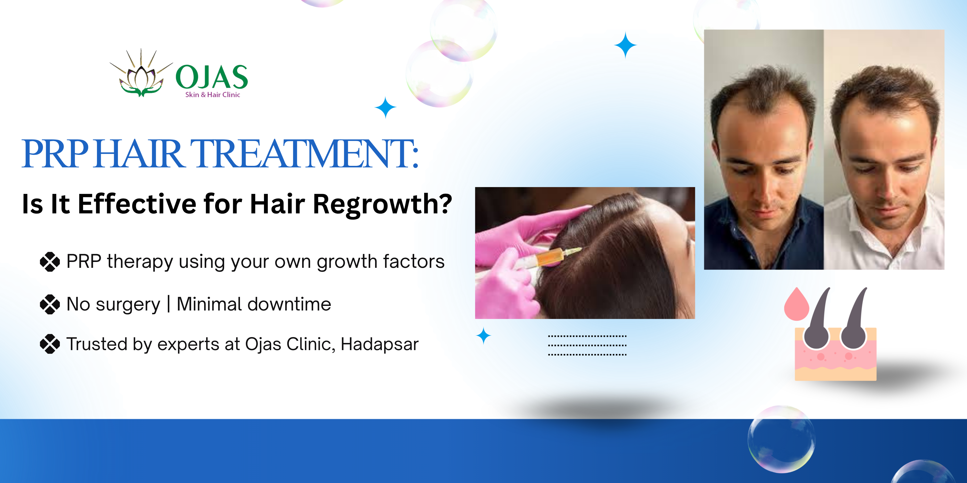 hair-clinic-near-me-prp-treatment-pune