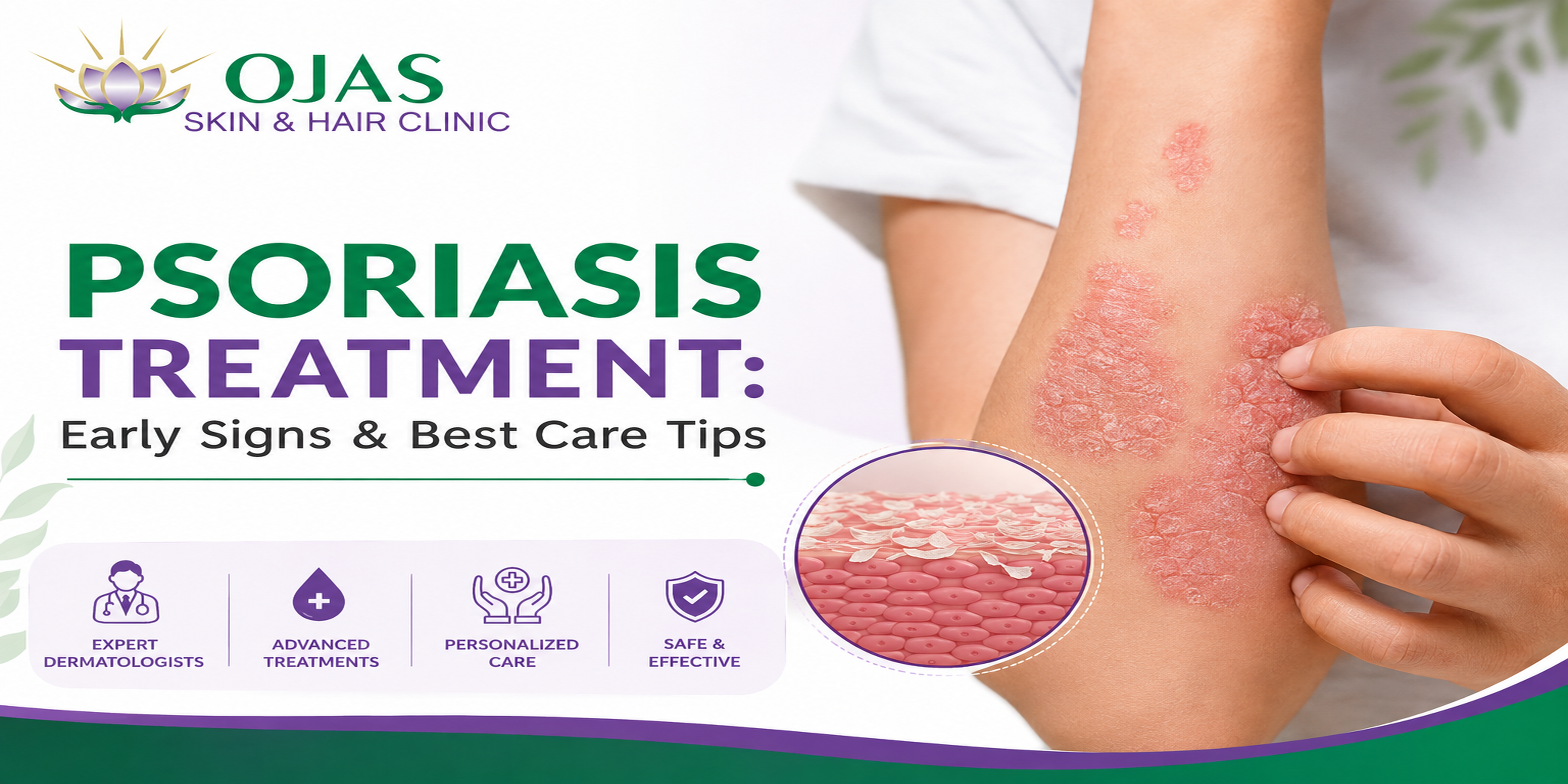 psoriasis-treatment-early-signs-care-tips