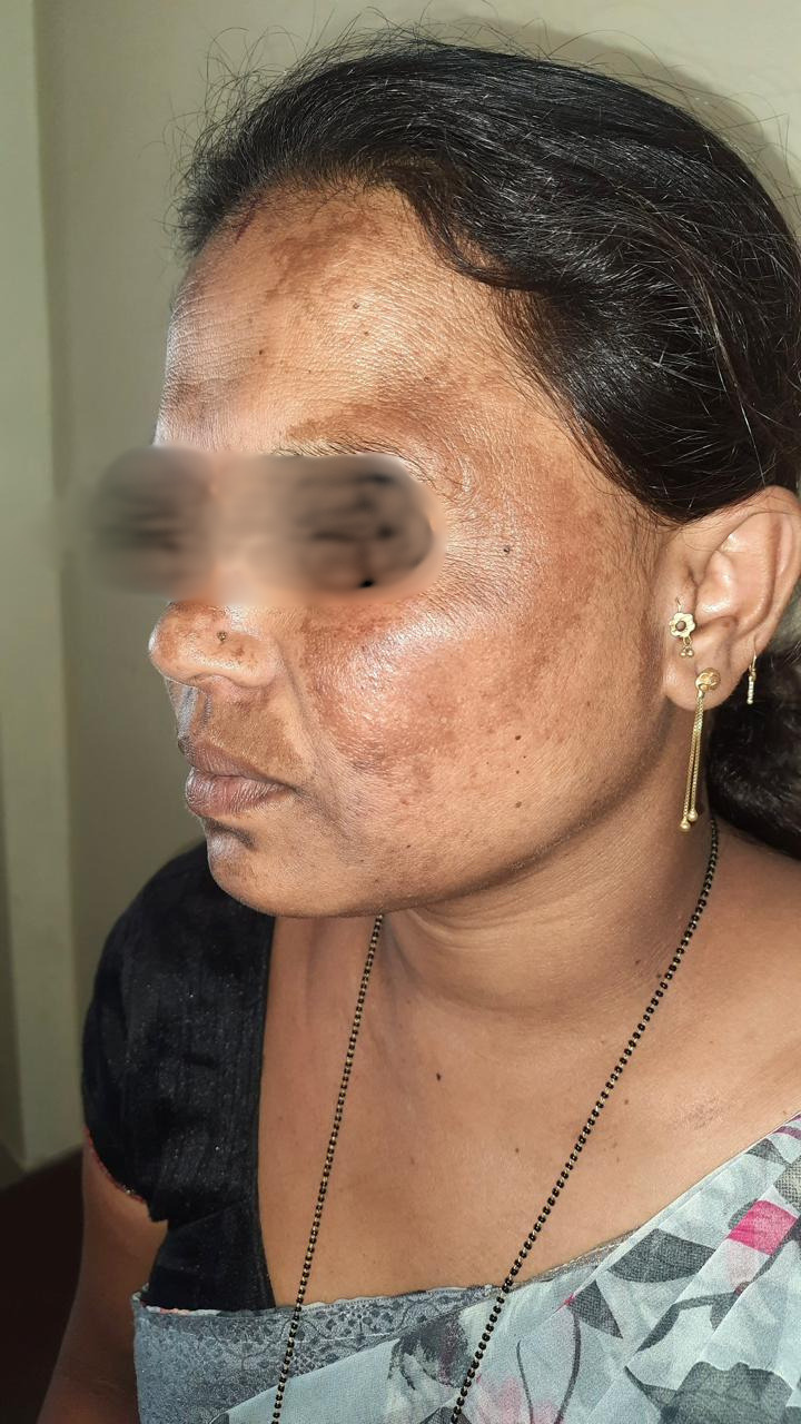 Skin Pigmentation