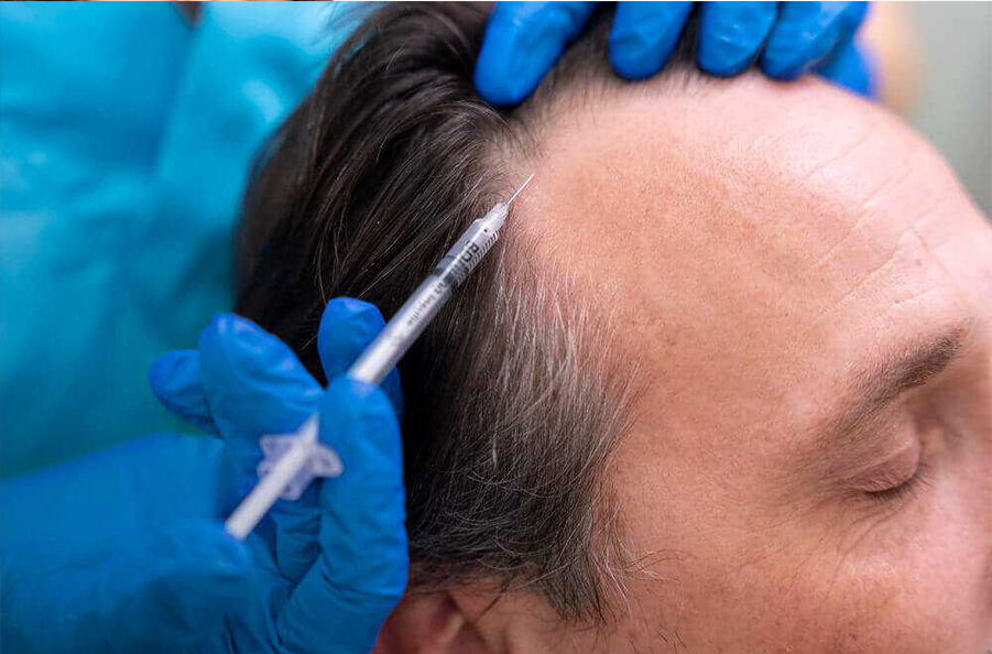 PRP For Hair