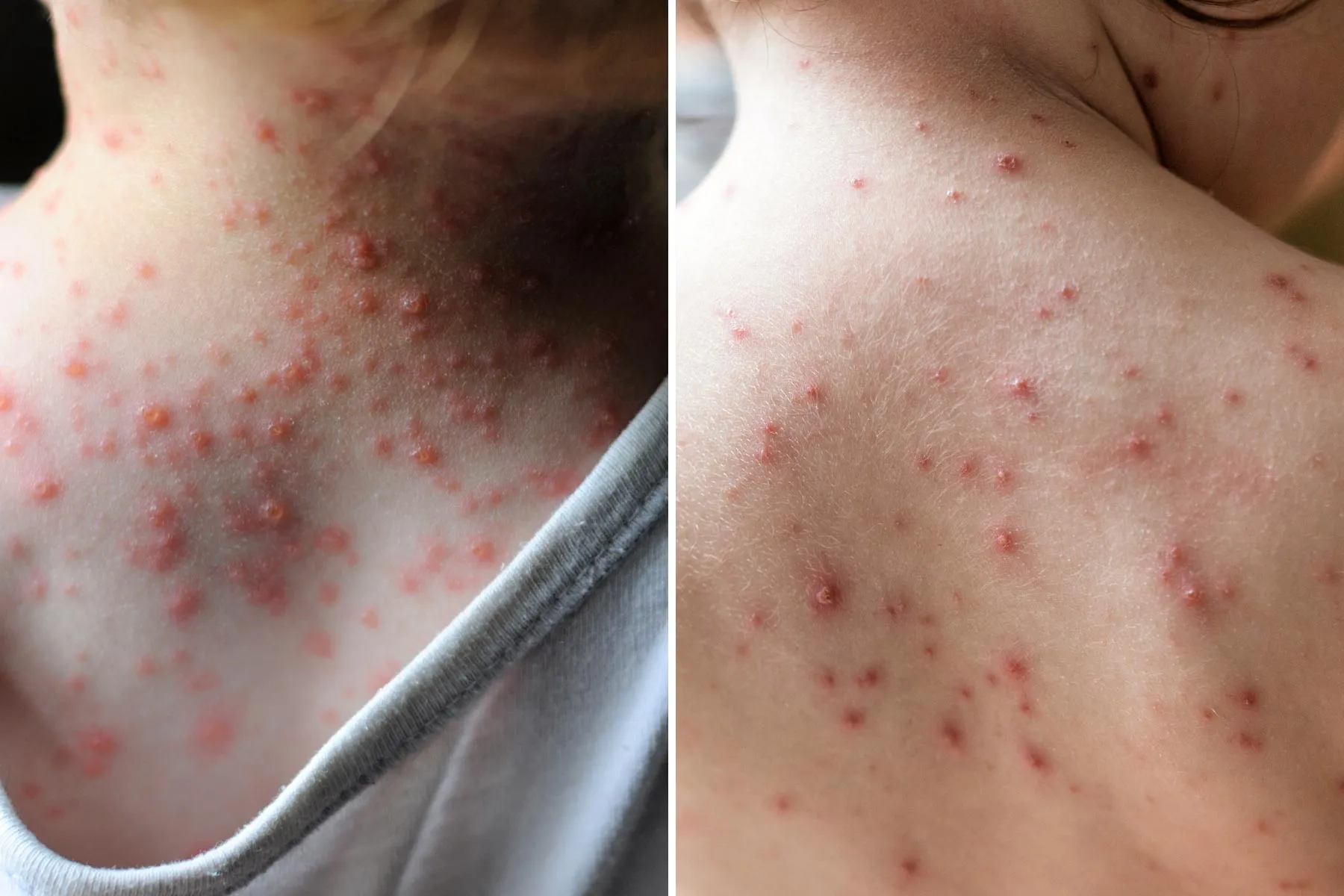 Chicken Pox Recovery