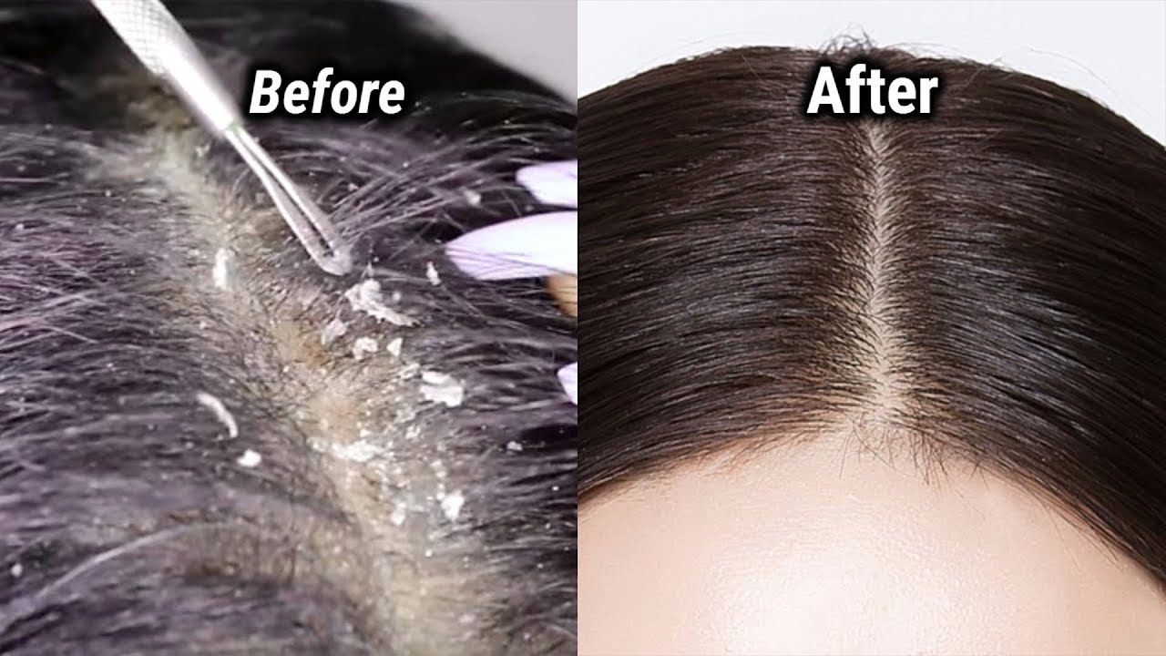 Scalp analysis
