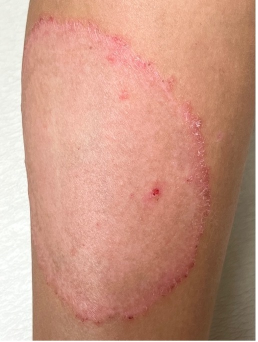 Fungal Infection
