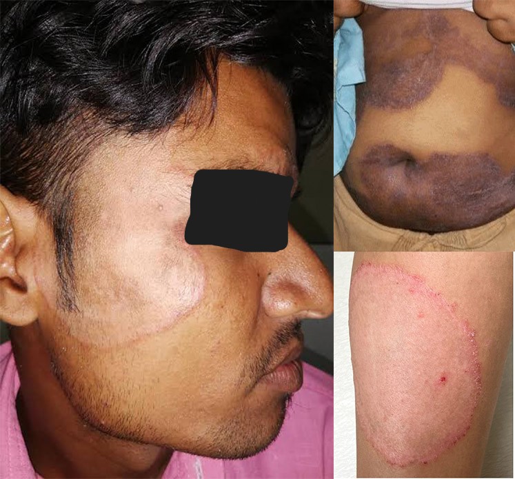 Fungal Infection Treatment