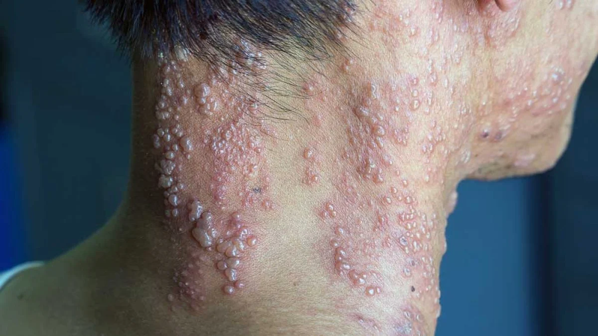 Herpes Zoster