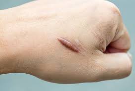  Keloid Treatment