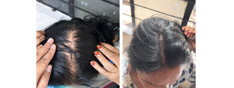Alopecia consultation