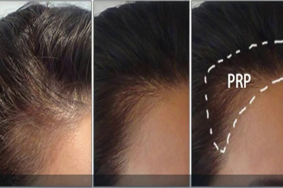 PRP procedure