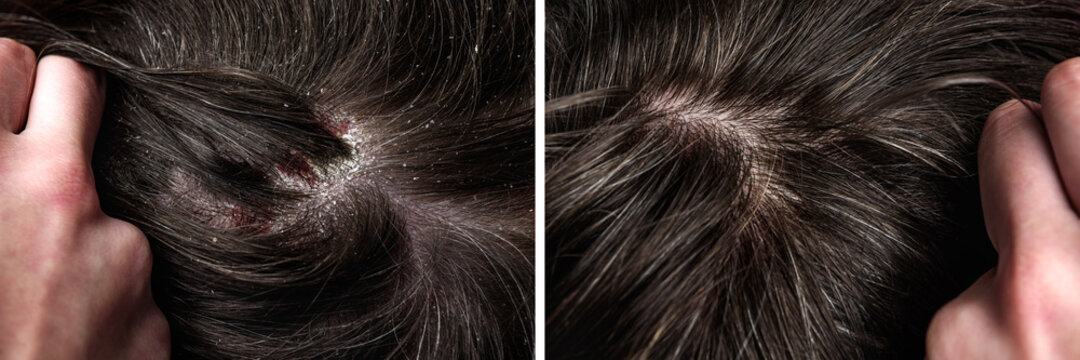 Psoriasis consultation