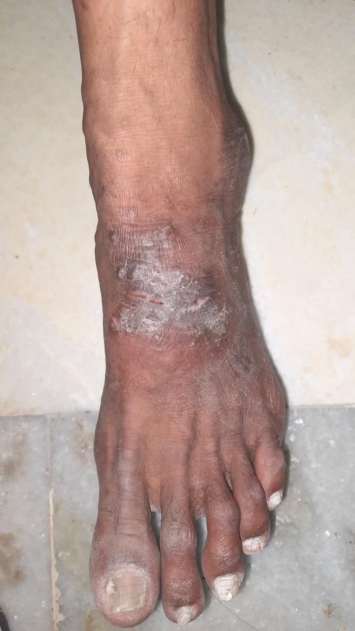 Eczema phototherapy