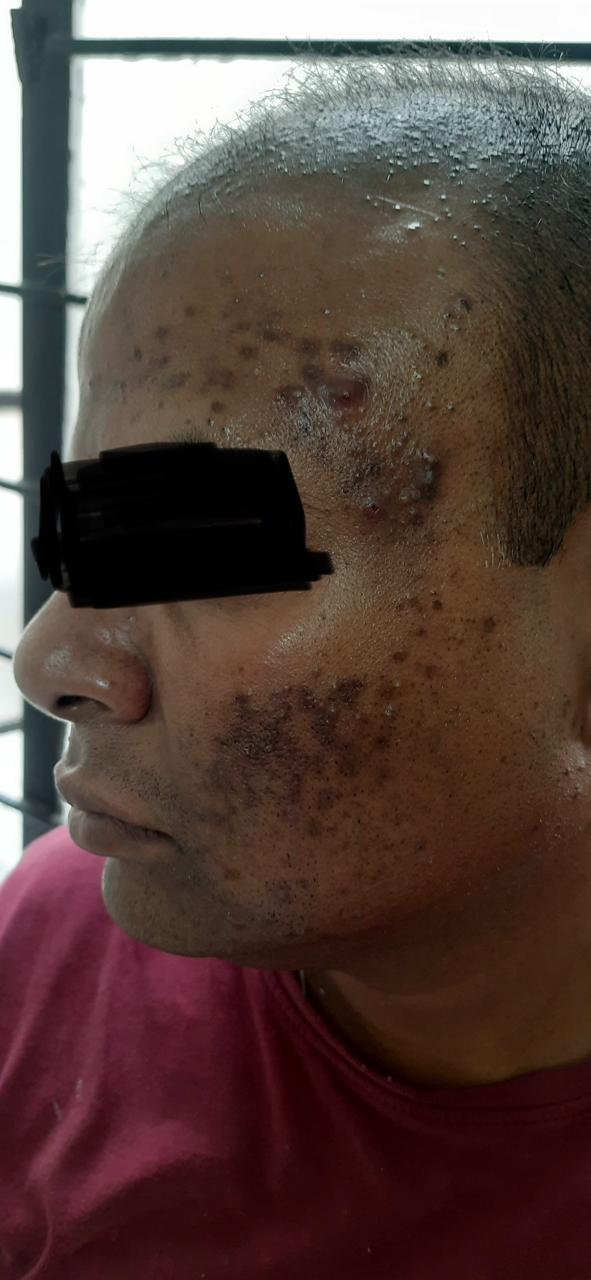 Skin  treatment