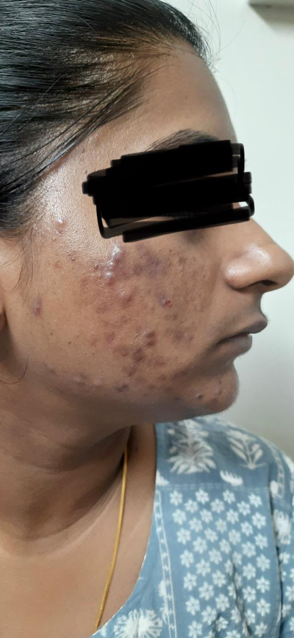 Skin  treatment