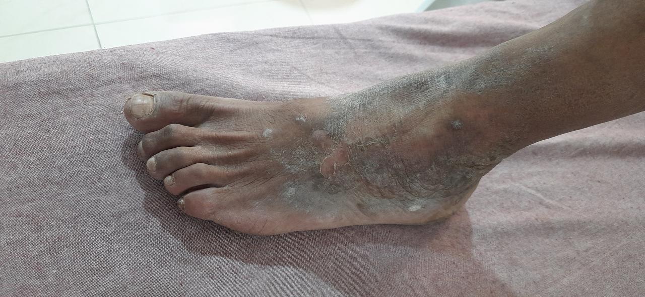 Skin  treatment