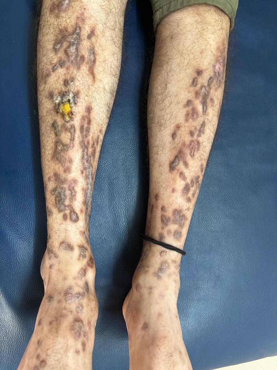 Eczema Treatment