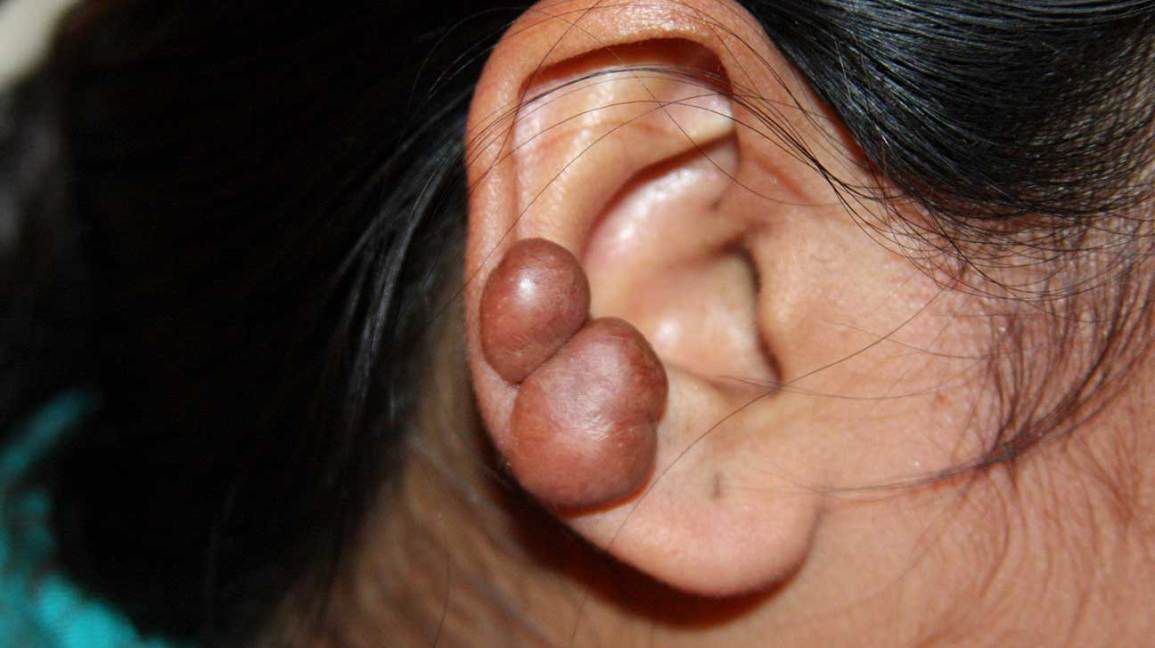Keloid Treatment