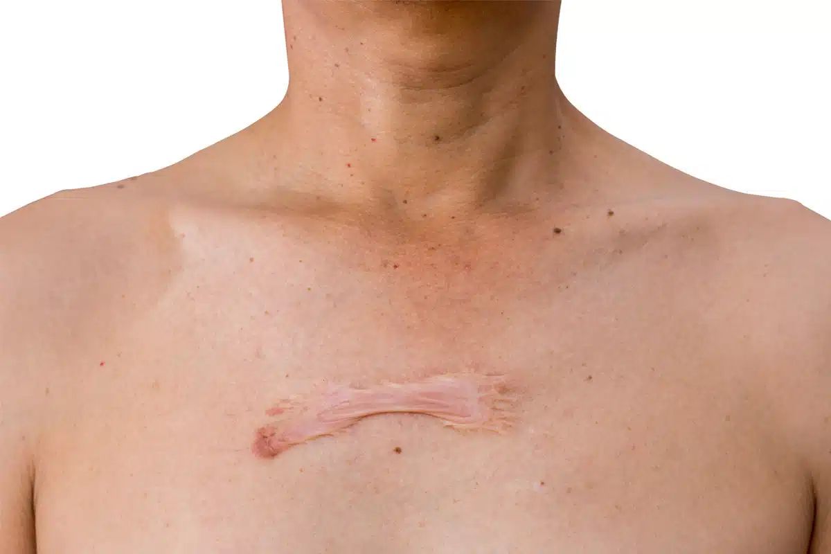 Keloid consultation