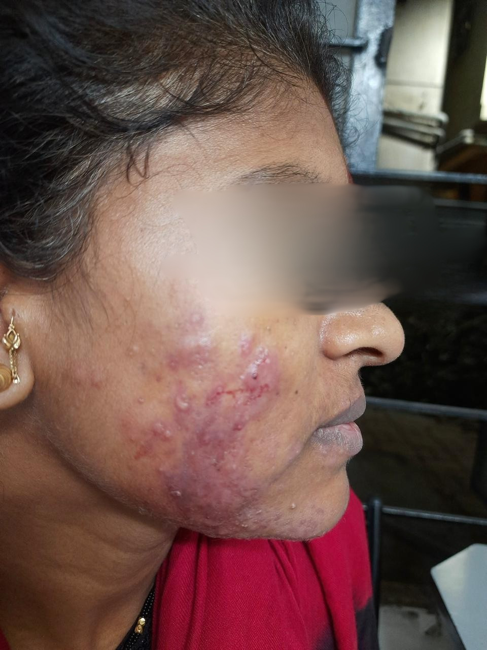 Skin  treatment