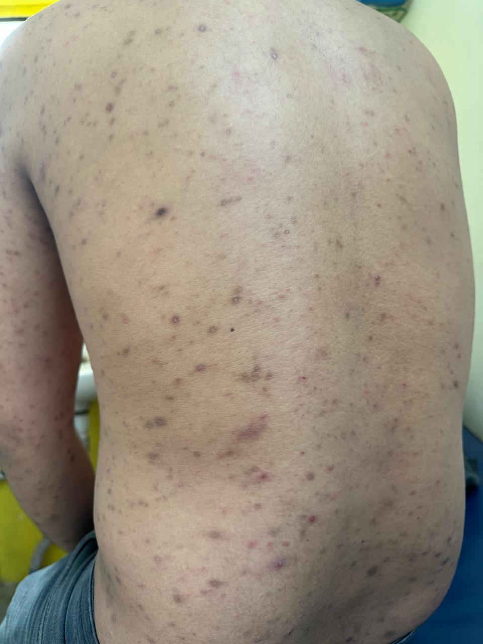 Skin  treatment