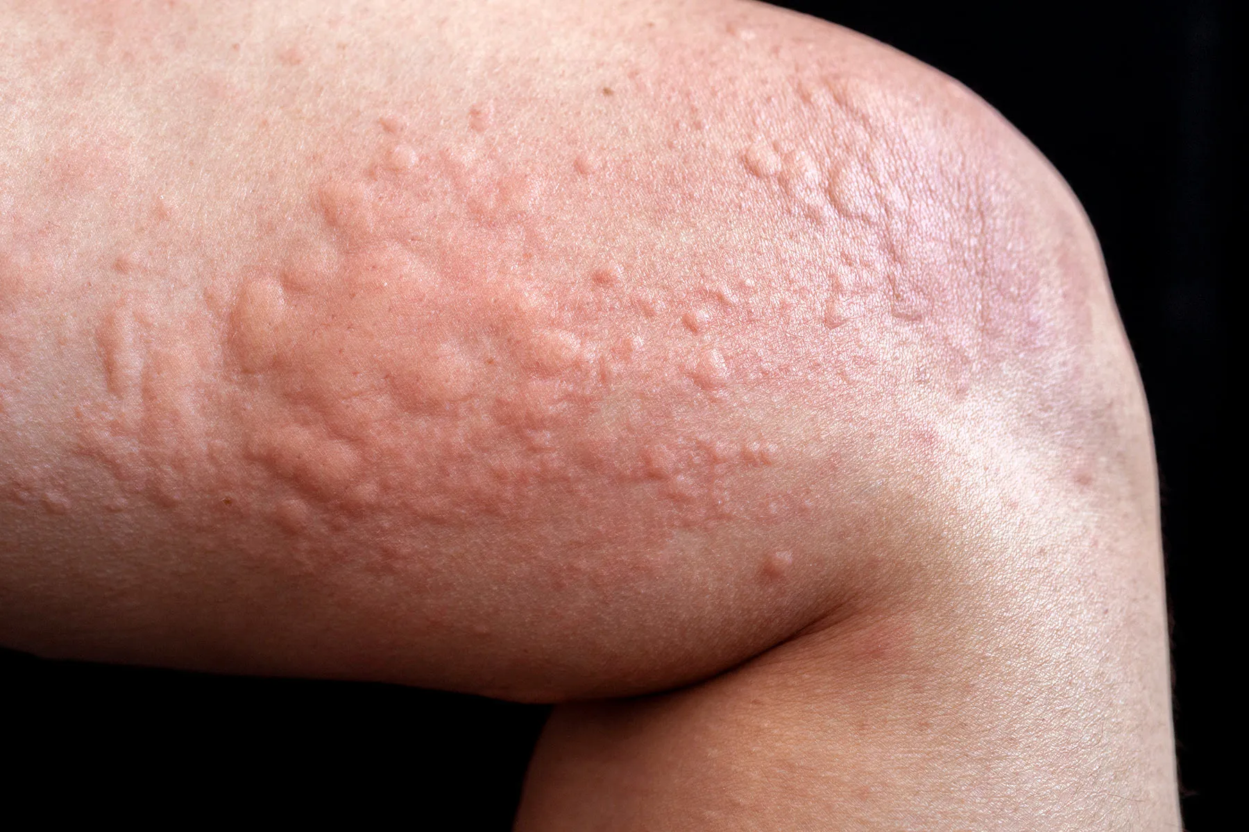 Allergy consultation