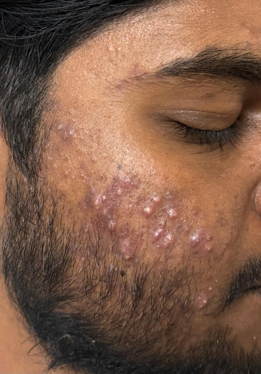Acne / Scar Treatment