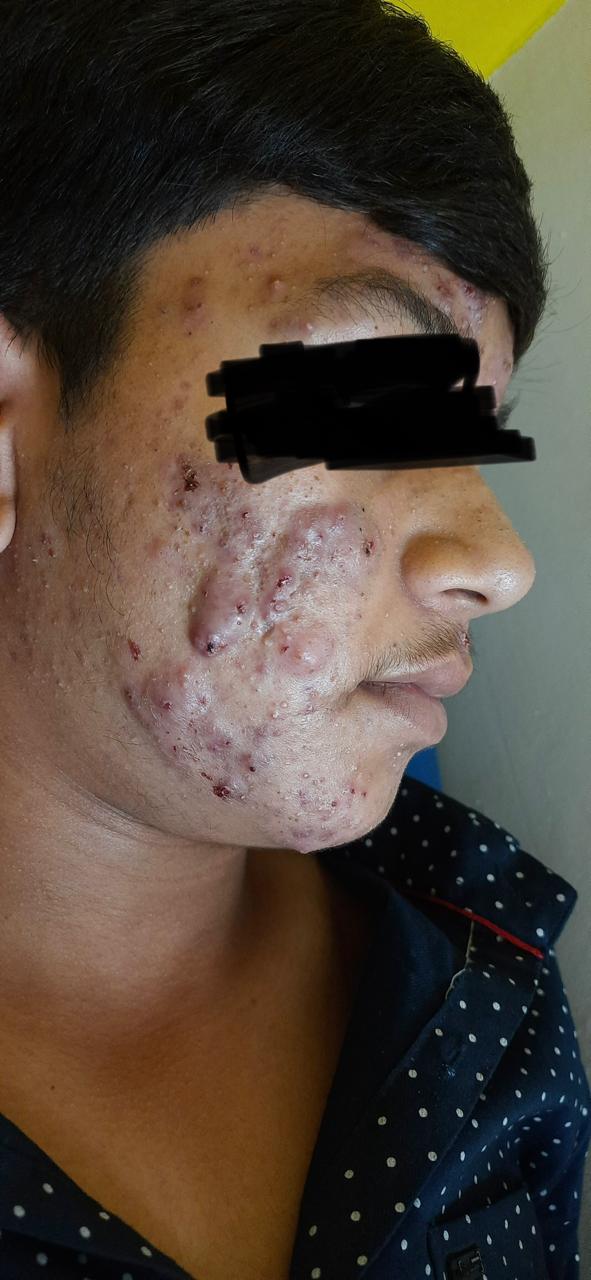 Skin  treatment