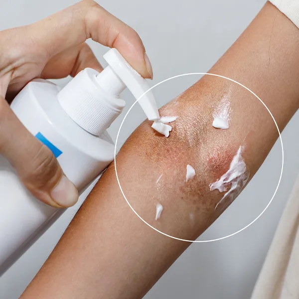Eczema consultation