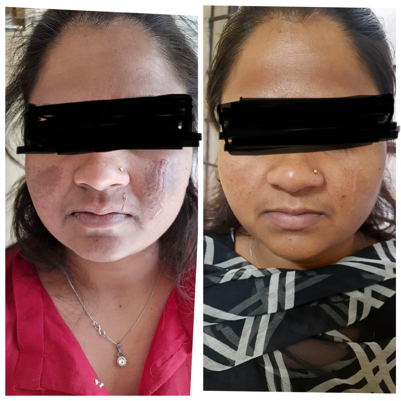 Eczema phototherapy