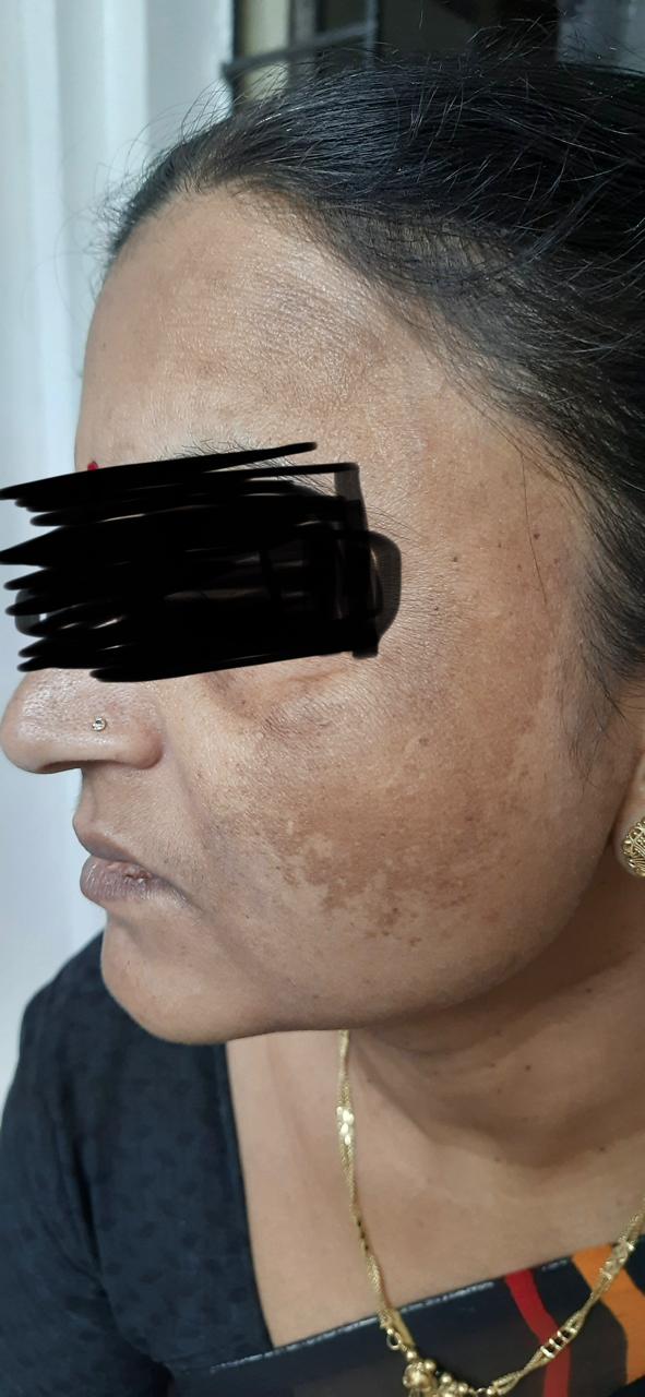Eczema phototherapy