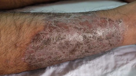 Eczema Treatment