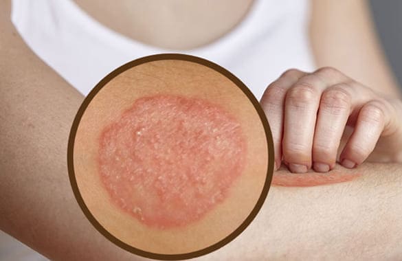 Fungal infection examination