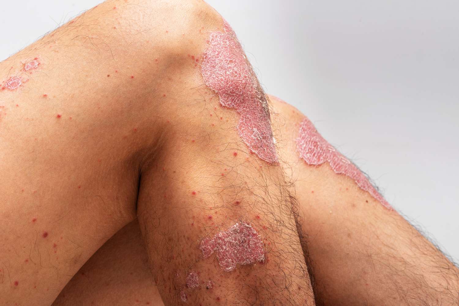 Phototherapy for psoriasis