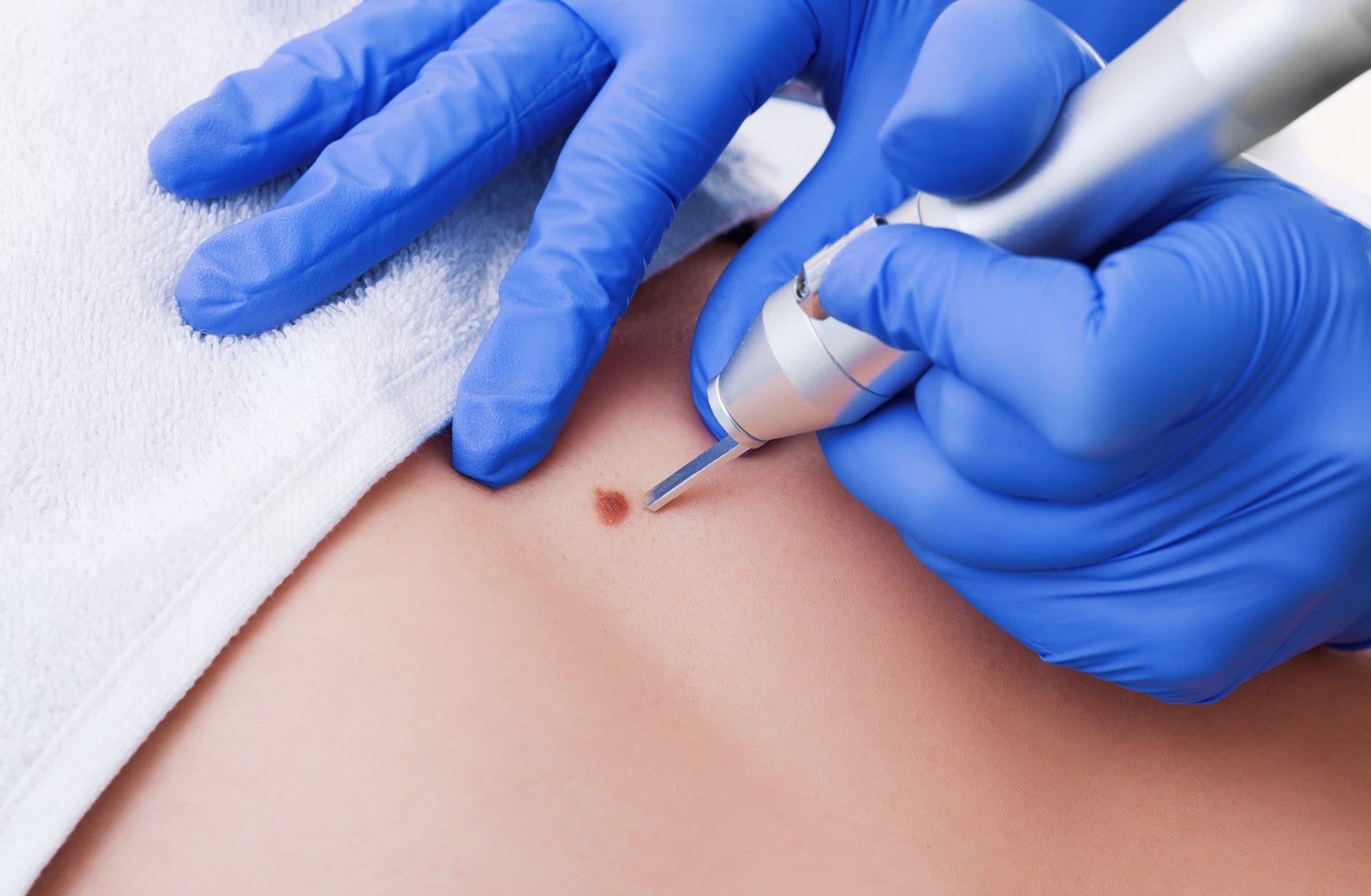 Skin tags removal results
