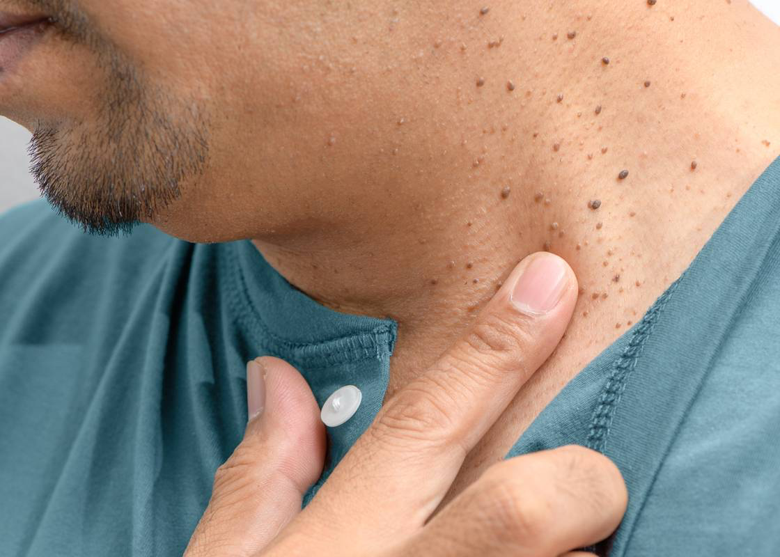 Skin Tags Removal