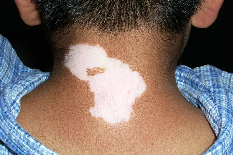 Vitiligo Treatment