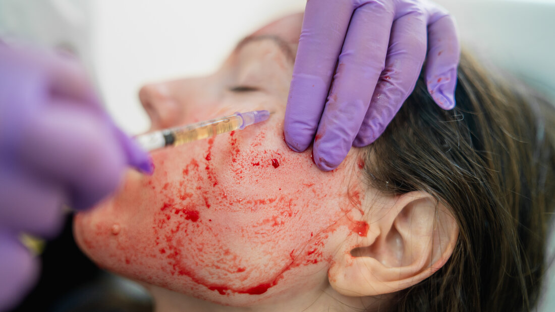 Vampire Facial results